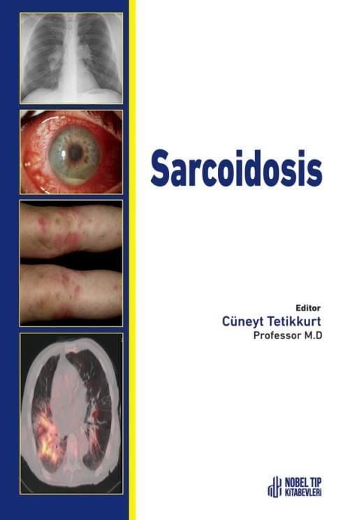 Sarcoidosis