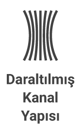 Kanal Daraltılmış