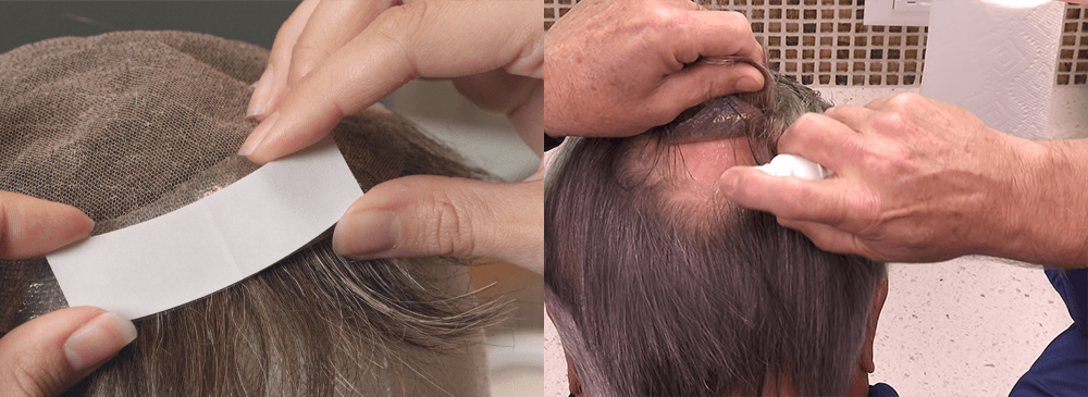 Protez Saç Sisteminin Uygulanması Ve Çıkarılması