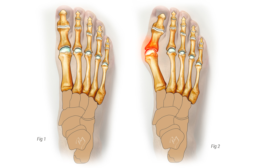 Ayak Baş Parmağı Çıkıntısı Tedavisi? Ayak başparmağı kemik çıkıntısı İçin Ayakkabılar