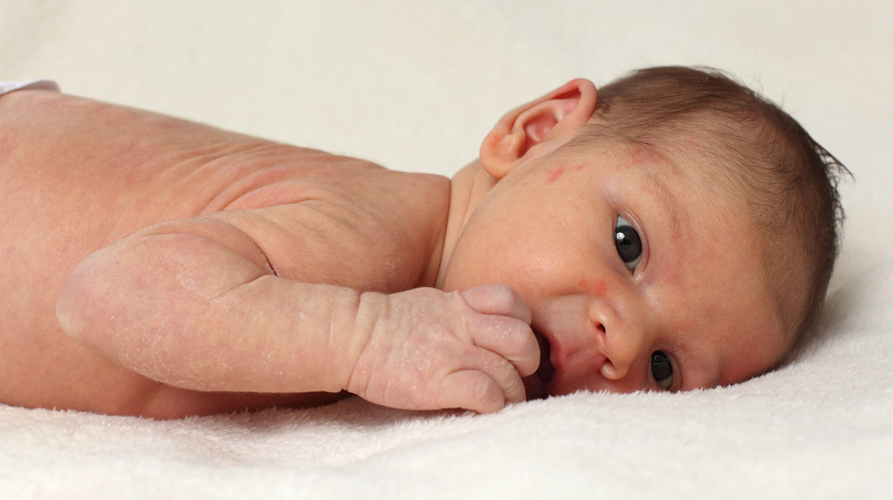 Bebeklerde Cilt Kuruluğu Neden Olur? Nasıl Geçer? | Dermoailem