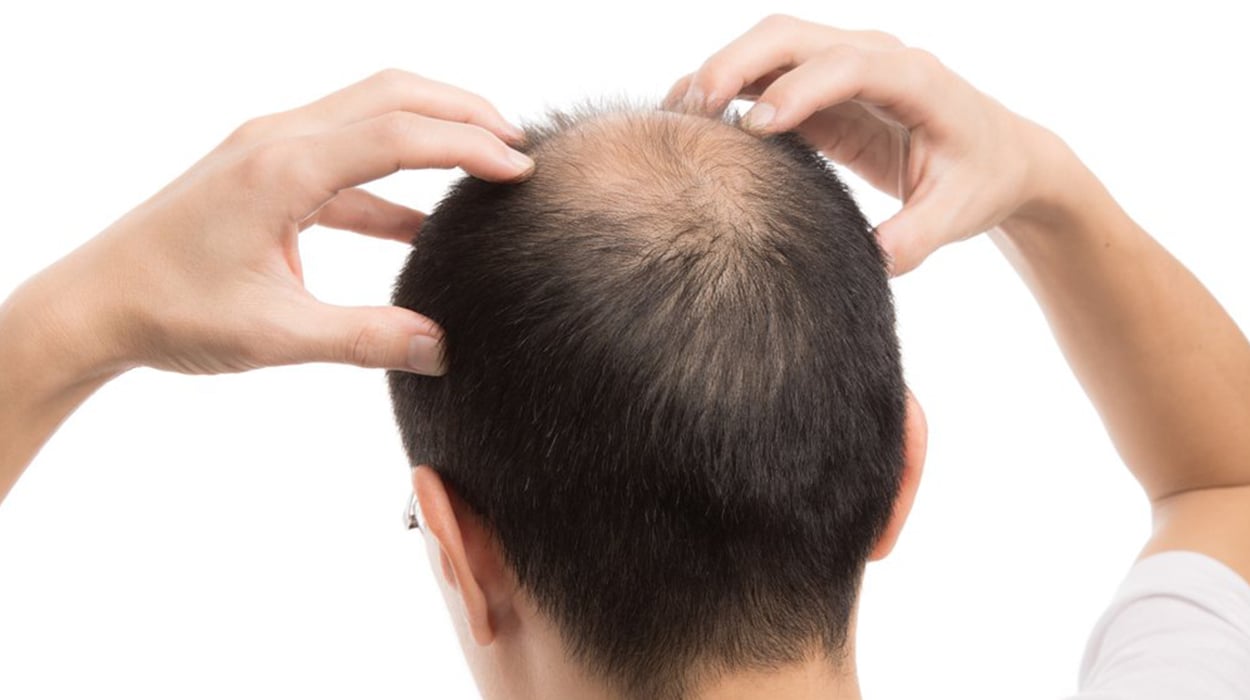 Erkeklerde Saç Dökülmesine Ne İyi Gelir? Nasıl Önlenir? | Dermoailem