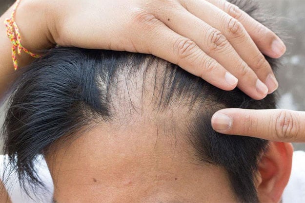 Saç Dökülmesi ve Nedenleri Nedir