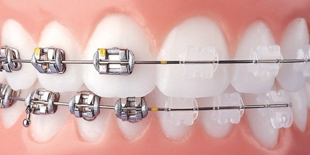 Alışkanlıklara Bağlı Ortaya Çıkan  Ön Açık Kapanışın Erken Ortodontik Tedavisi