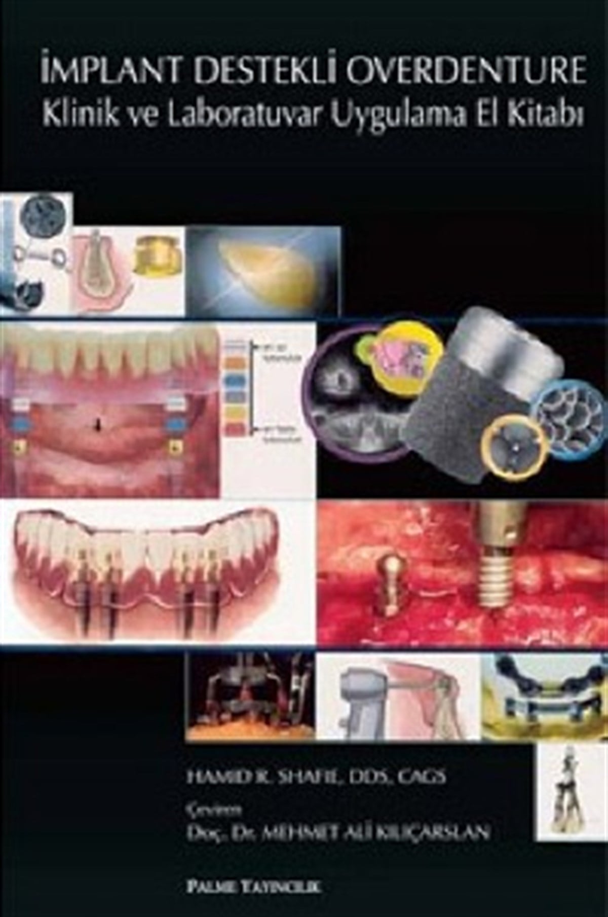İmplant Destekli Overdenture Klinik ve Laboratuvar Uygulama El Kitabı