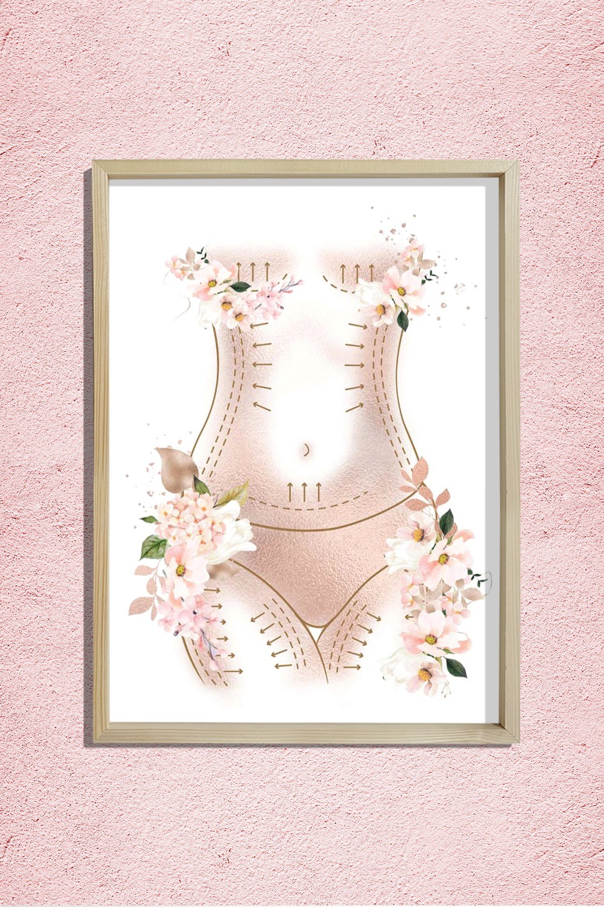 Anne Estetiği , Karın Germe Sanatı, Liposuction, Plastik ve Estetik Cerrahı, Doktor Odası Duvar Tablosu