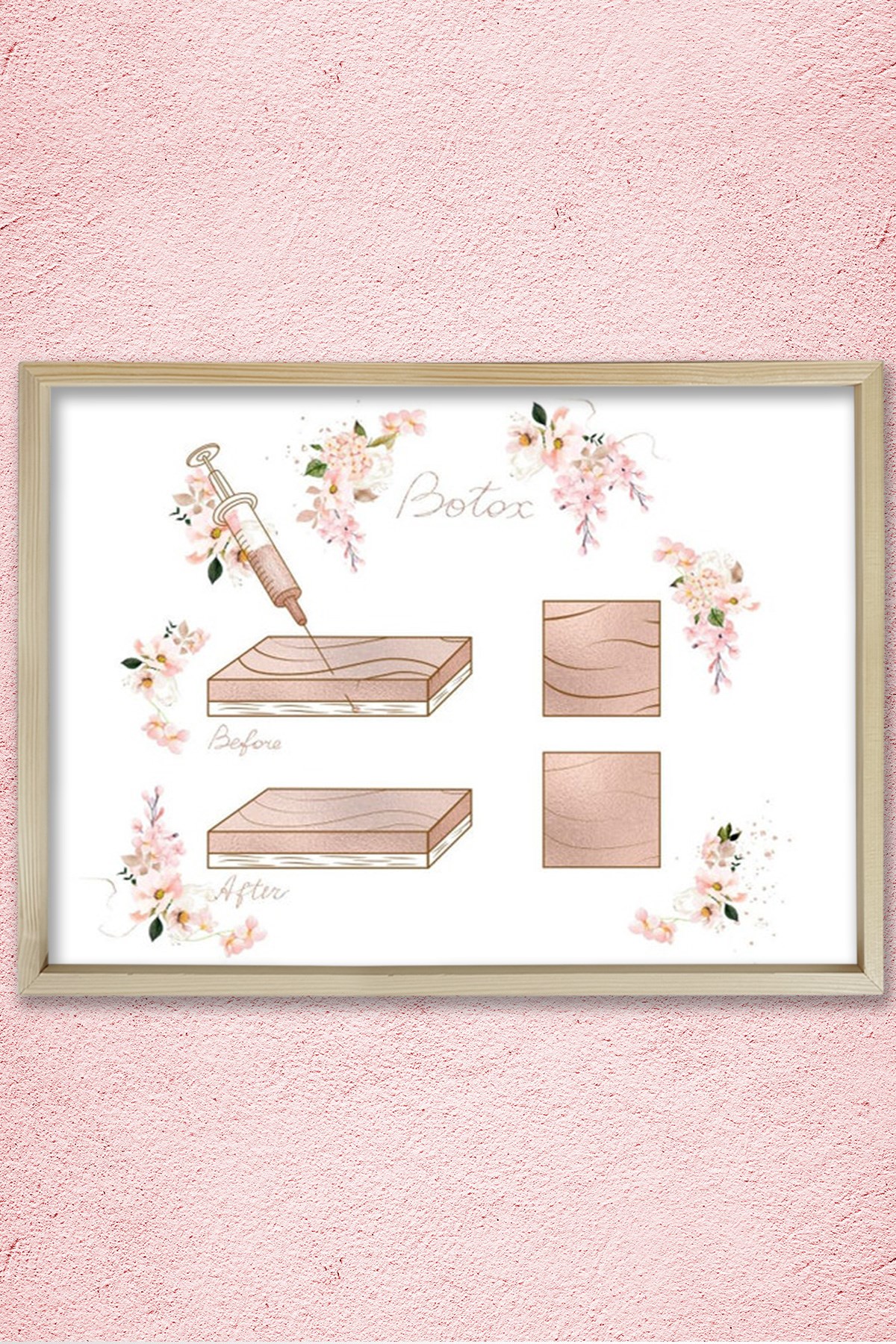 Botox Enjeksiyon Noktaları, Öncesi ve Sonrası, Plastik ve Estetik Cerrahı, Doktor Odası Duvar Tablosu