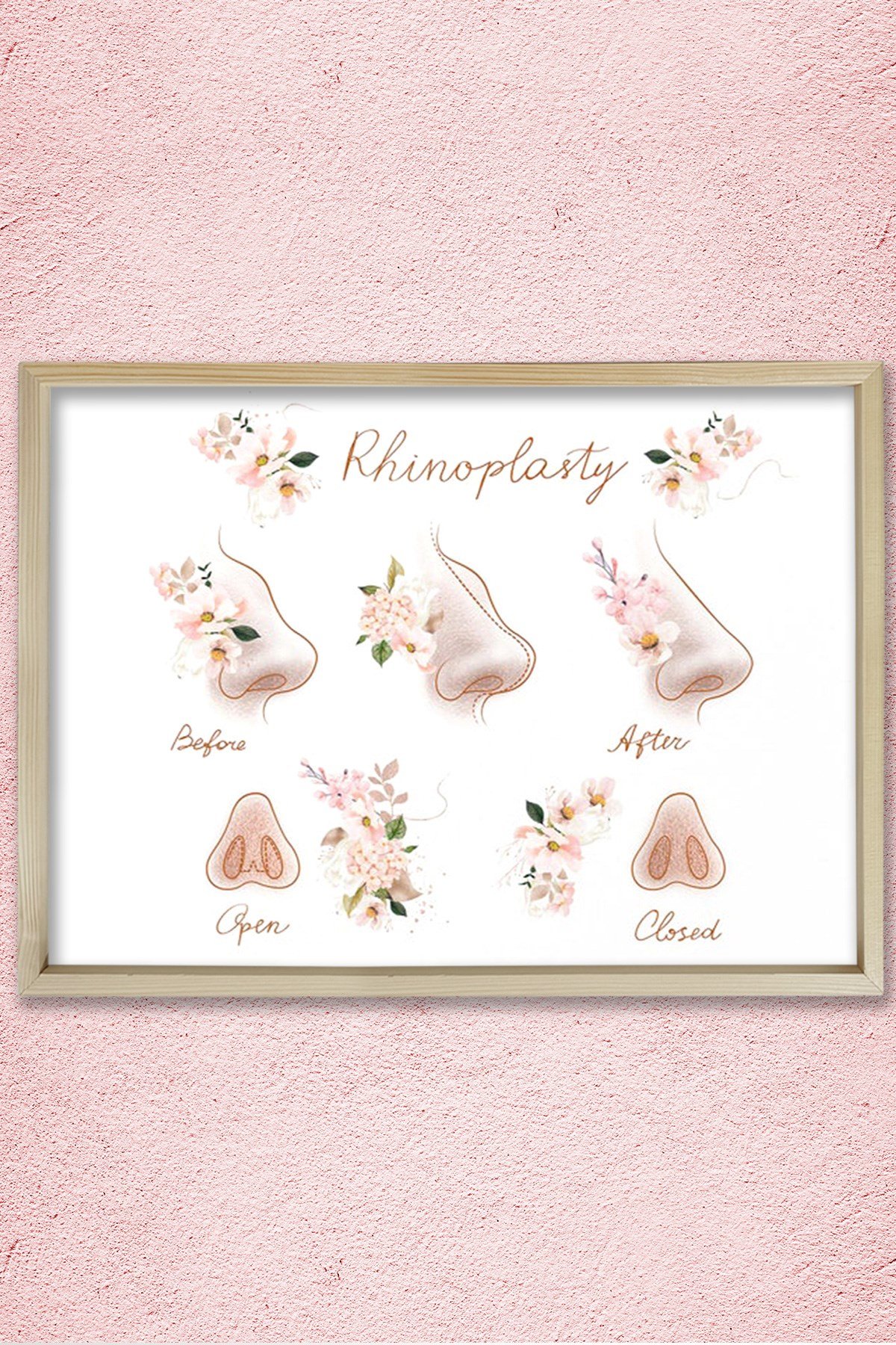 Burun Estetiği, Plastik ve Estetik Cerrahı, Doktor Odası Duvar Tablosu