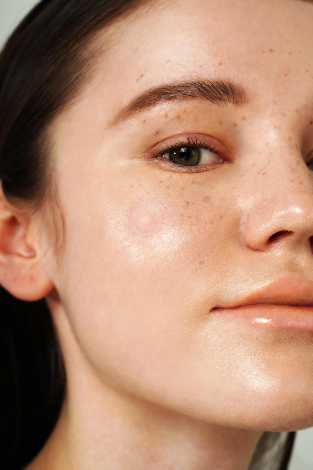 Isntree Onion Newpair Spot Patch - Basic 24 Adet (12mm*12 & 10mm*12) (Niacinamide İçeren Akne Kapatıcı, Sivilce Bandı)