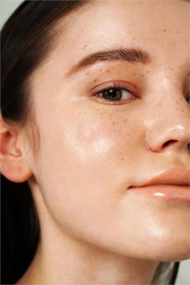 Isntree Onion Newpair Spot Patch - Basic 24 Adet (12mm*12 & 10mm*12) (Niacinamide İçeren Akne Kapatıcı, Sivilce Bandı)