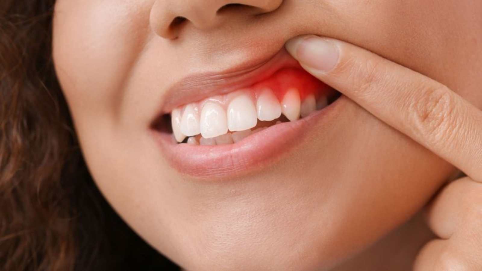 Diş Eti İltihabı Nedir, Nasıl Tedavi Edilir?