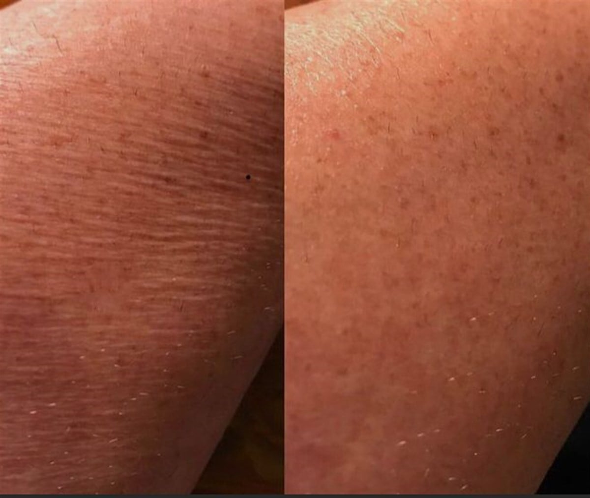 Cold Plazma Cihazı