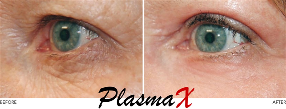 PlasmaX Pen Estetik Cihazı