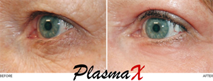 PlasmaX Pen Estetik Cihazı