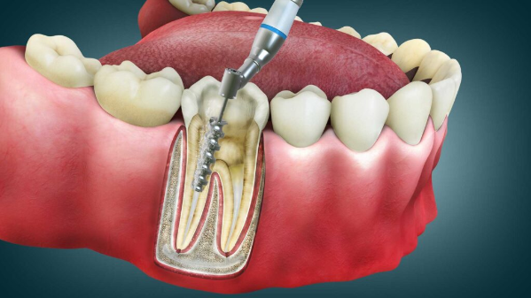Endodontik Tedavi Nedir ve Nasıl Uygulanır?