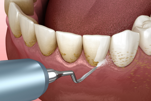 Periodontoloji Nedir? Periodontoloji Ne Yapar?