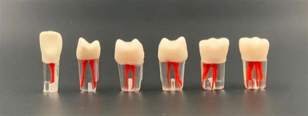 Endodontik Kanallı Kronlu Dişler