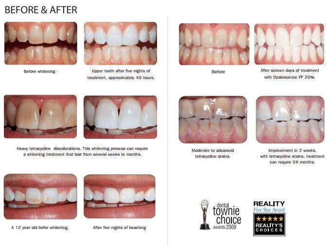 Ultradent Opalescence PF 16% Ev Tipi Beyazlatma