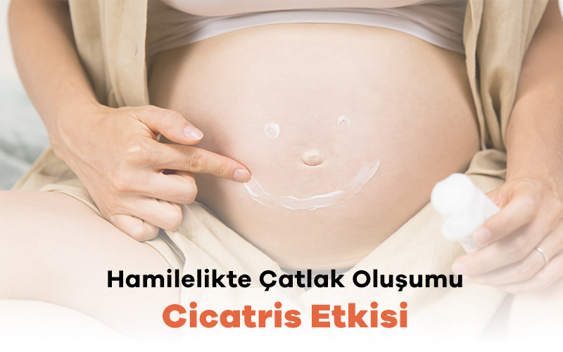 Cicatris ile Hamilelikte Çatlakları Önlemek