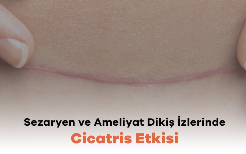 Sezaryen ve Ameliyat Dikiş İzlerinde Cicatris Etkisi