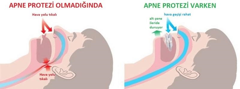 Uyku Apnesi Tedavisi Nedir?