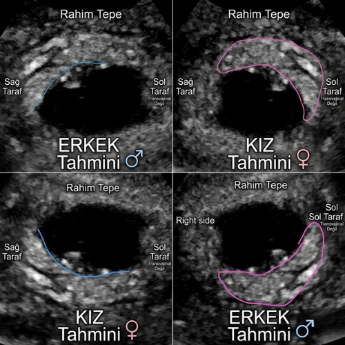 Ramzi teorisine göre karından ultrason görüntülerinde sağ ve sol plasenta yerleşimine dayalı erkek ve kız bebek cinsiyet tahmini şeması.