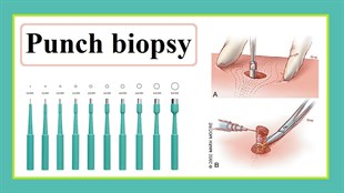 Biopsy Punch