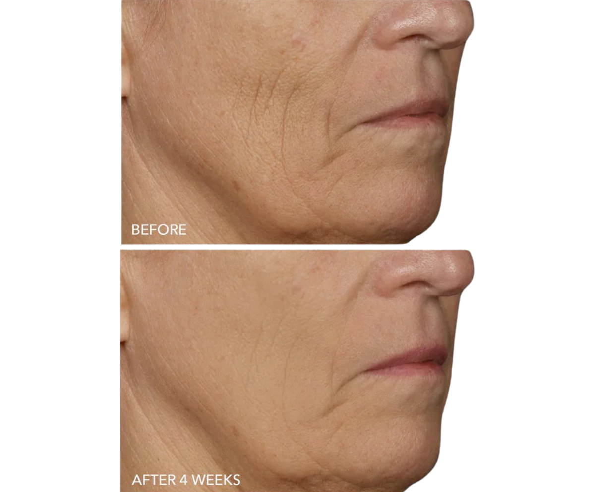 DRx SpectraLite FaceWare Pro