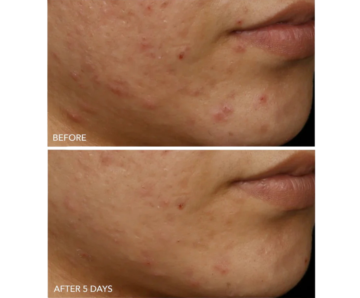 DRx SpectraLite FaceWare Pro