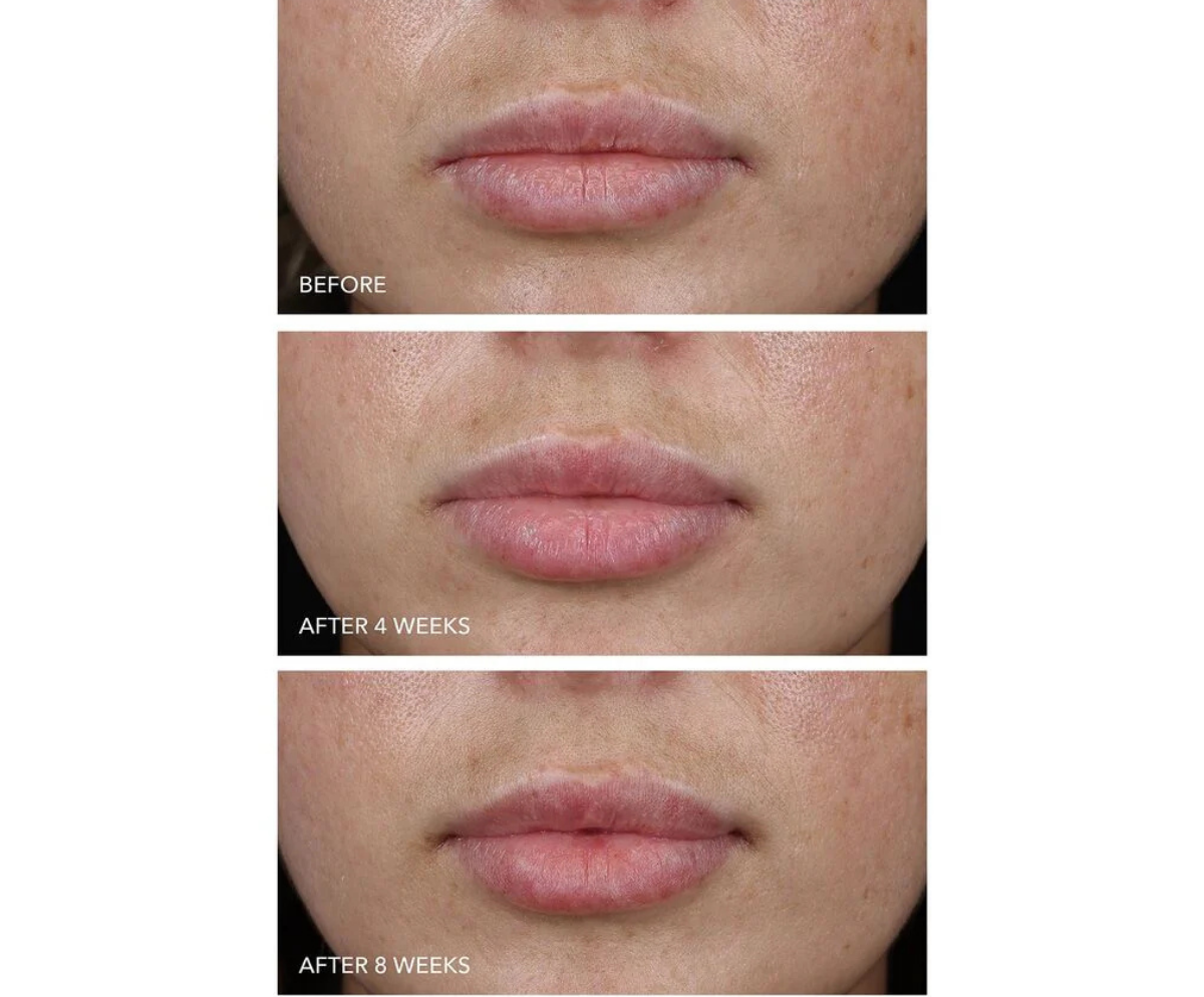 DRx SpectraLite LipWare Pro