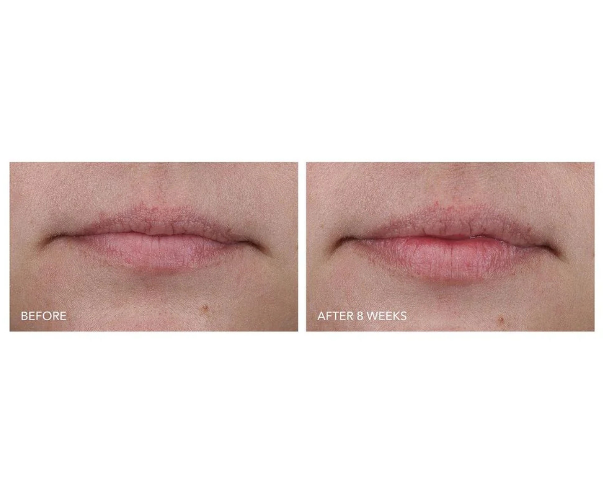 DRx SpectraLite LipWare Pro
