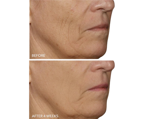 DRx SpectraLite FaceWare Pro