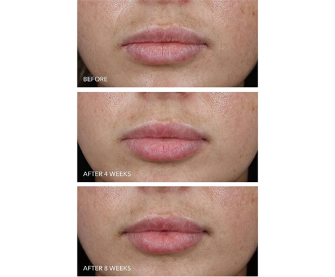 DRx SpectraLite LipWare Pro