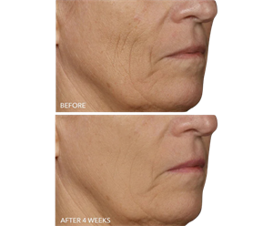 DRx SpectraLite FaceWare Pro