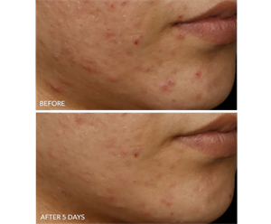 DRx SpectraLite FaceWare Pro