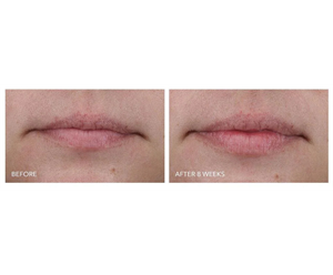 DRx SpectraLite LipWare Pro
