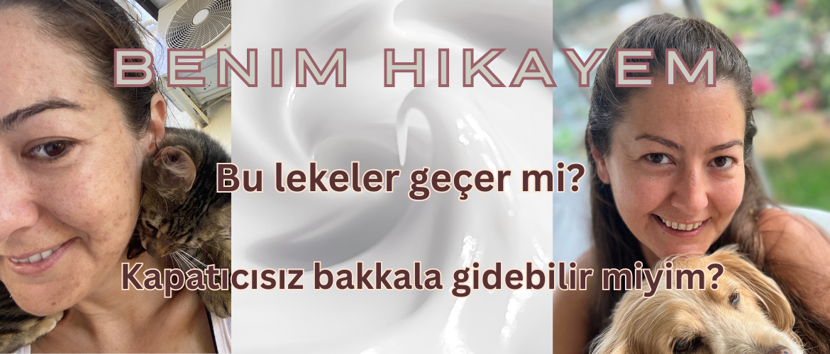 Benim Hikayem - Cildim nasıl iyileşti?