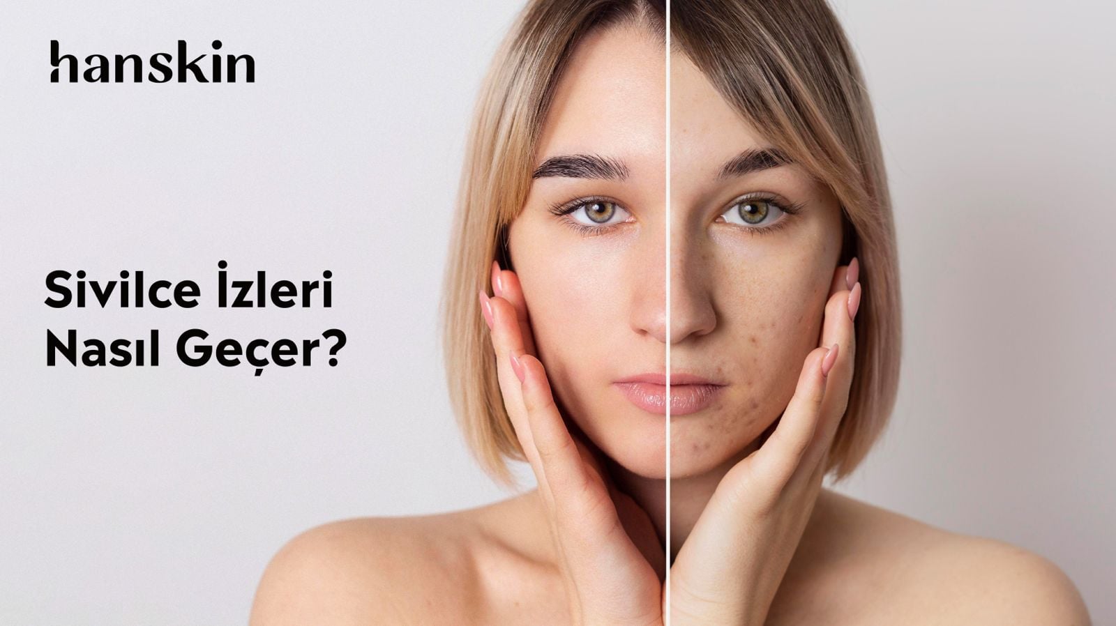 Sivilce İzleri Nasıl Geçer? Leke Kalmadan İyileşme Yolları