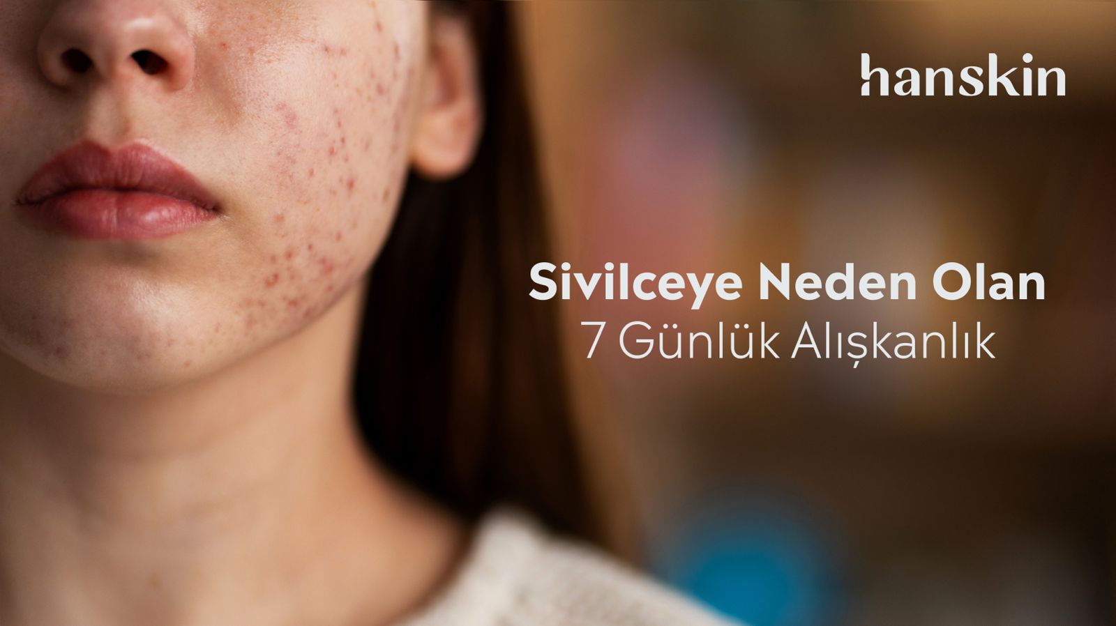 Sivilceye Neden Olan 7 Günlük Alışkanlık (Ve Bunlardan Nasıl Kurtulursun?)