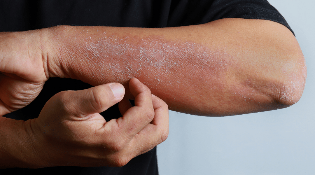 Atopik Dermatit Sabunlar Nelerdir