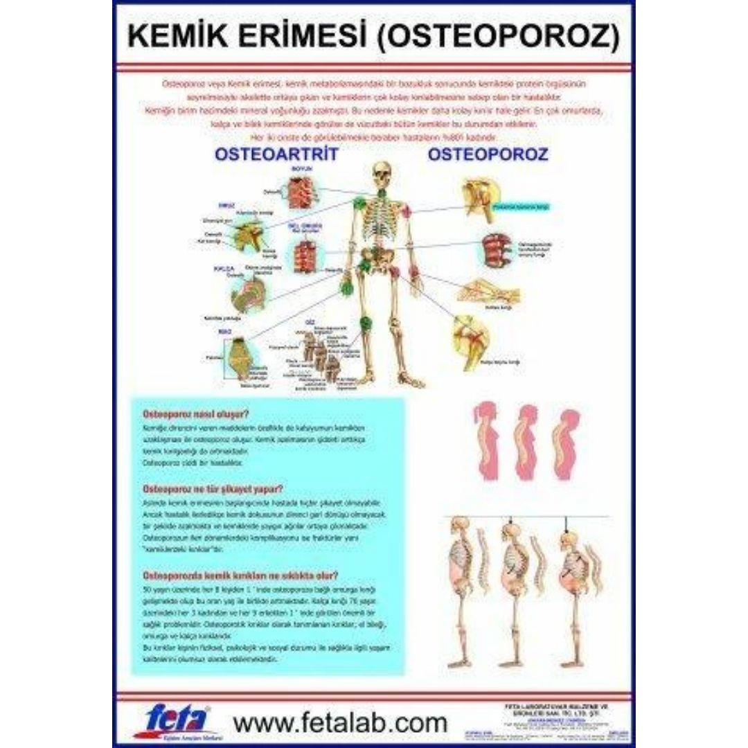 Oscar Osteoporosis Education Plate (Osteoporosis) Oscar Educational