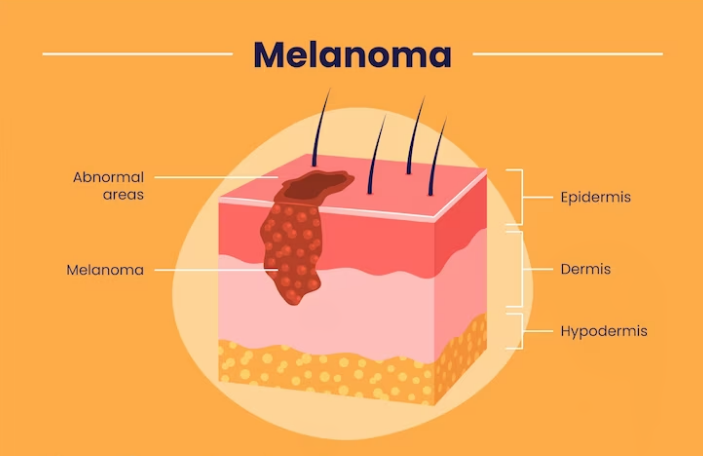 Melanom