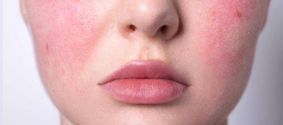 Rosacea,Rosacea için güneş koruyucu seçimi,Kızarıklığı azaltan doğal içerikli kremler,Hipoalerjenik ürünlerle rosacea tedavisi,