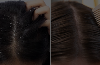 Rosemary Oil: Nature's Touch for Hair and Skin