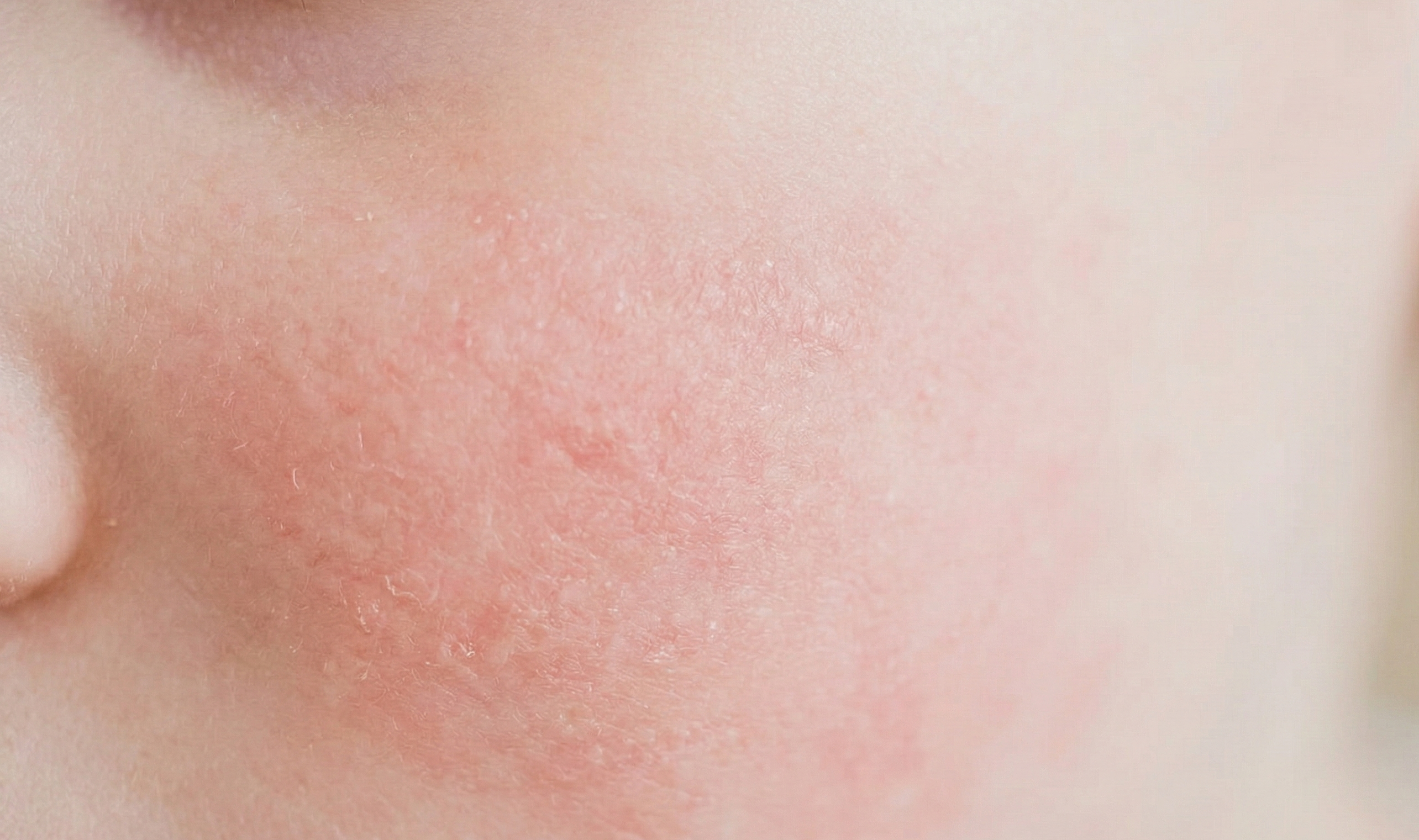 Atopik Dermatitli Ciltlerde Nemlendirici Kullanmak Neden Önemlidir?
