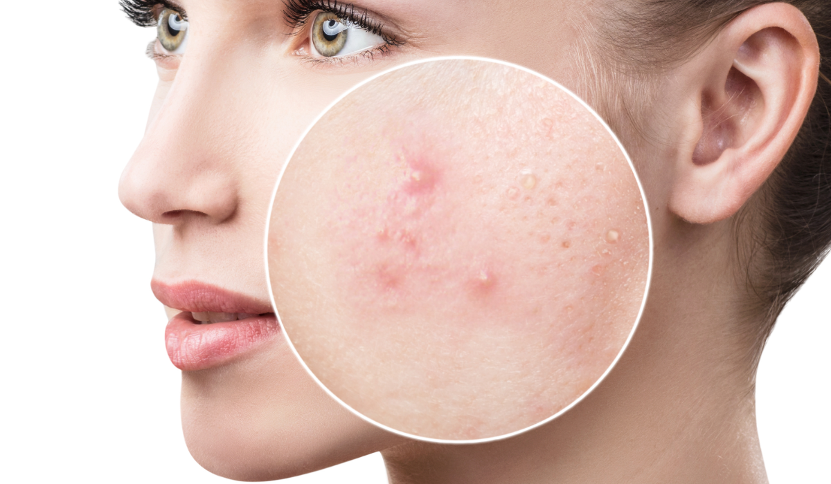 Propionibacterium Acnes!