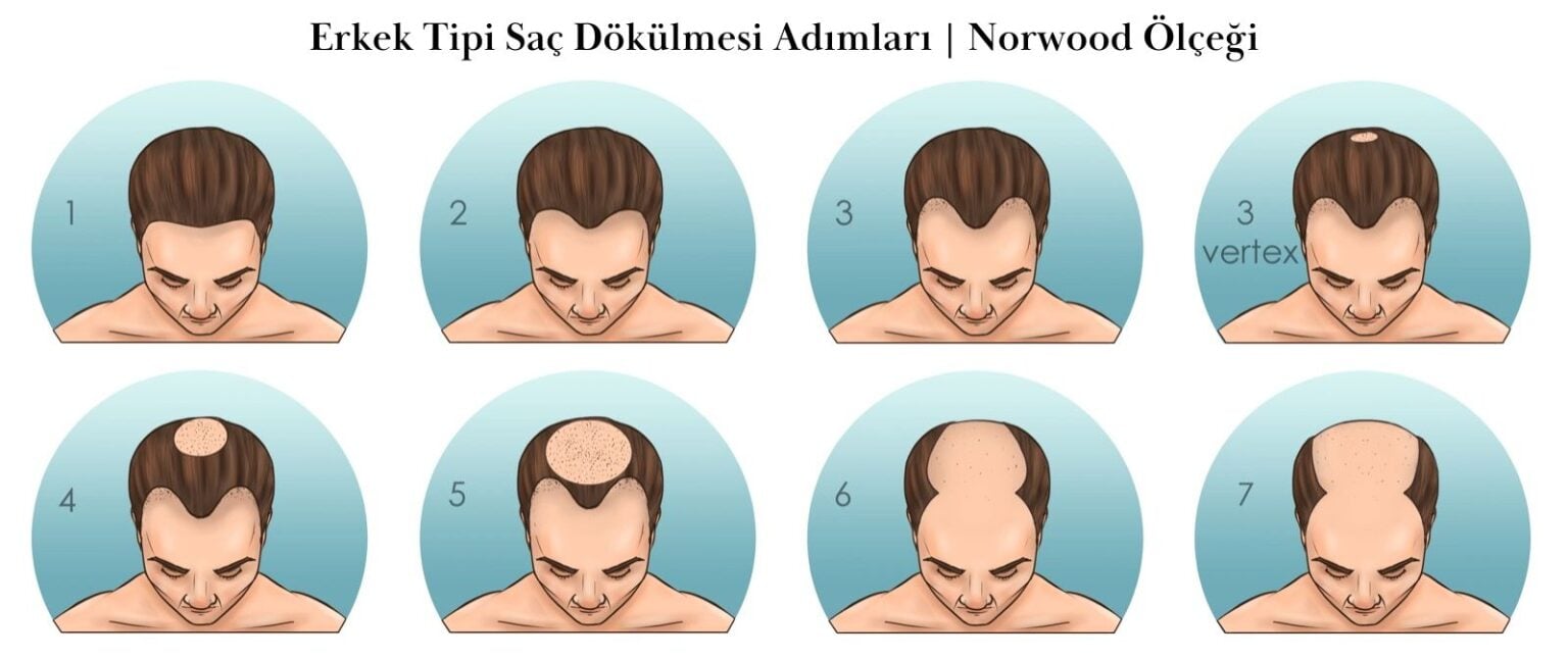 Saç Dökülmesinin Nedenleri ve Çözümleri