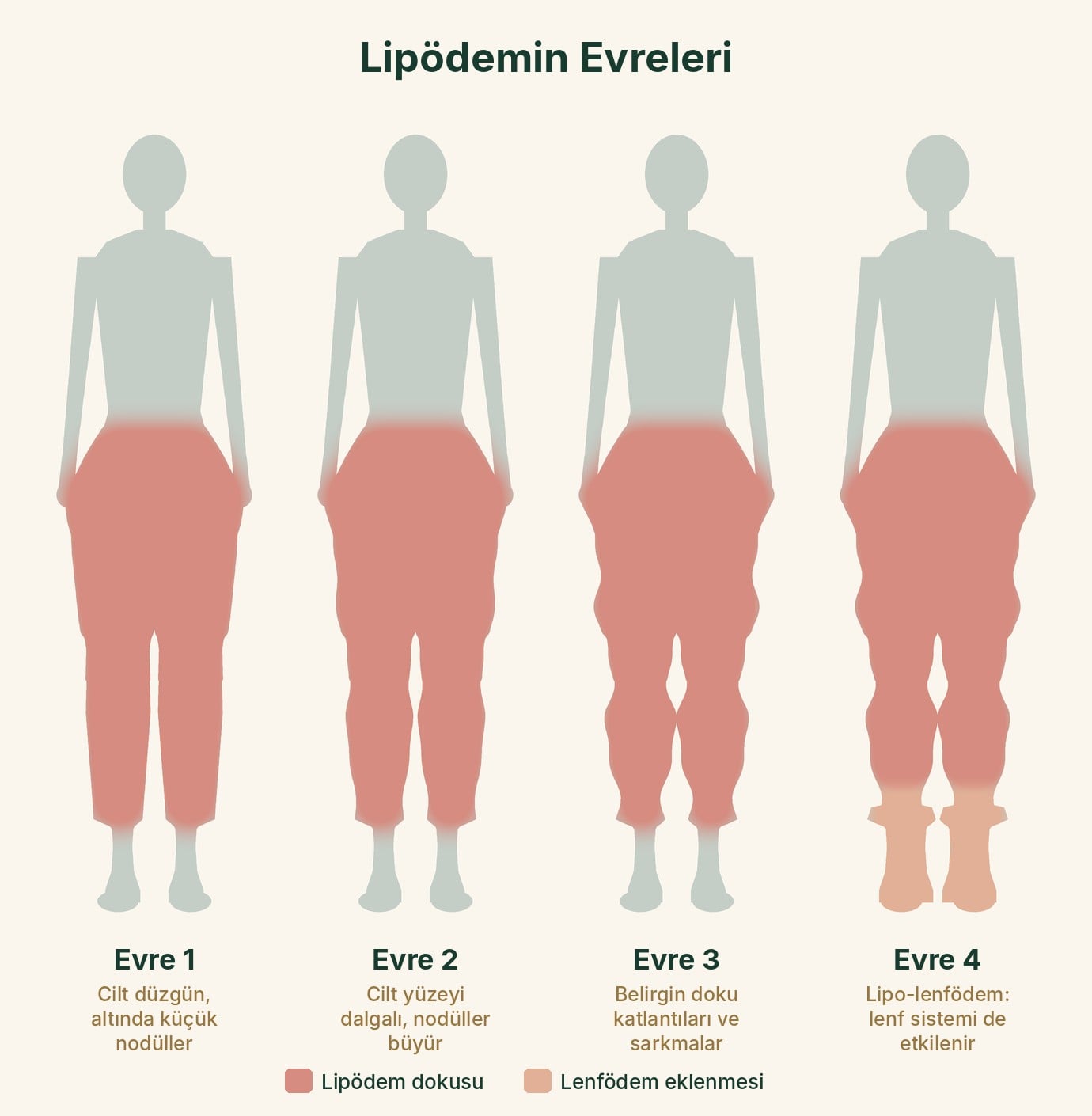 Lipödemin klasik dört evresi
