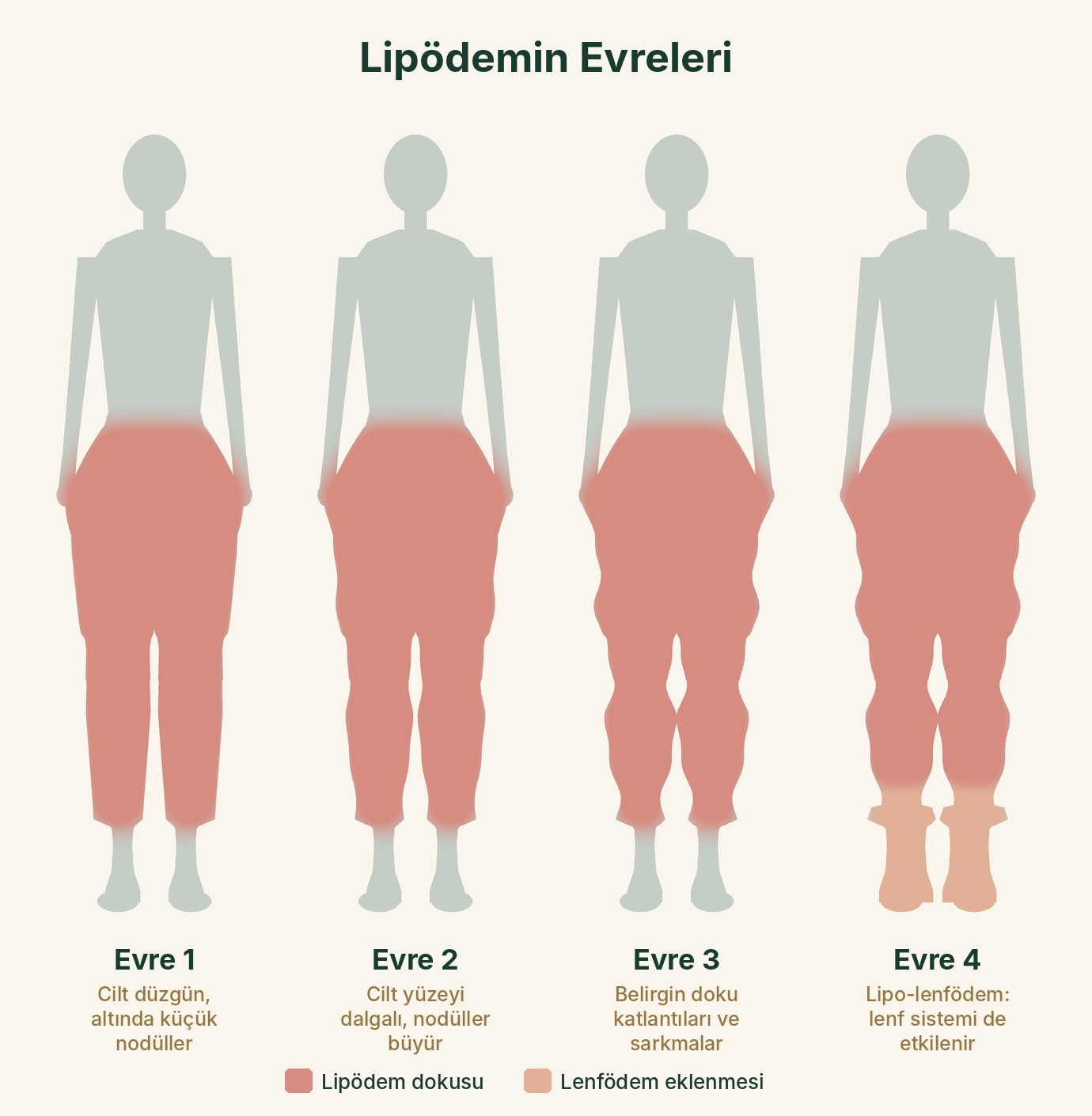 Lipödemin klasik dört evresi