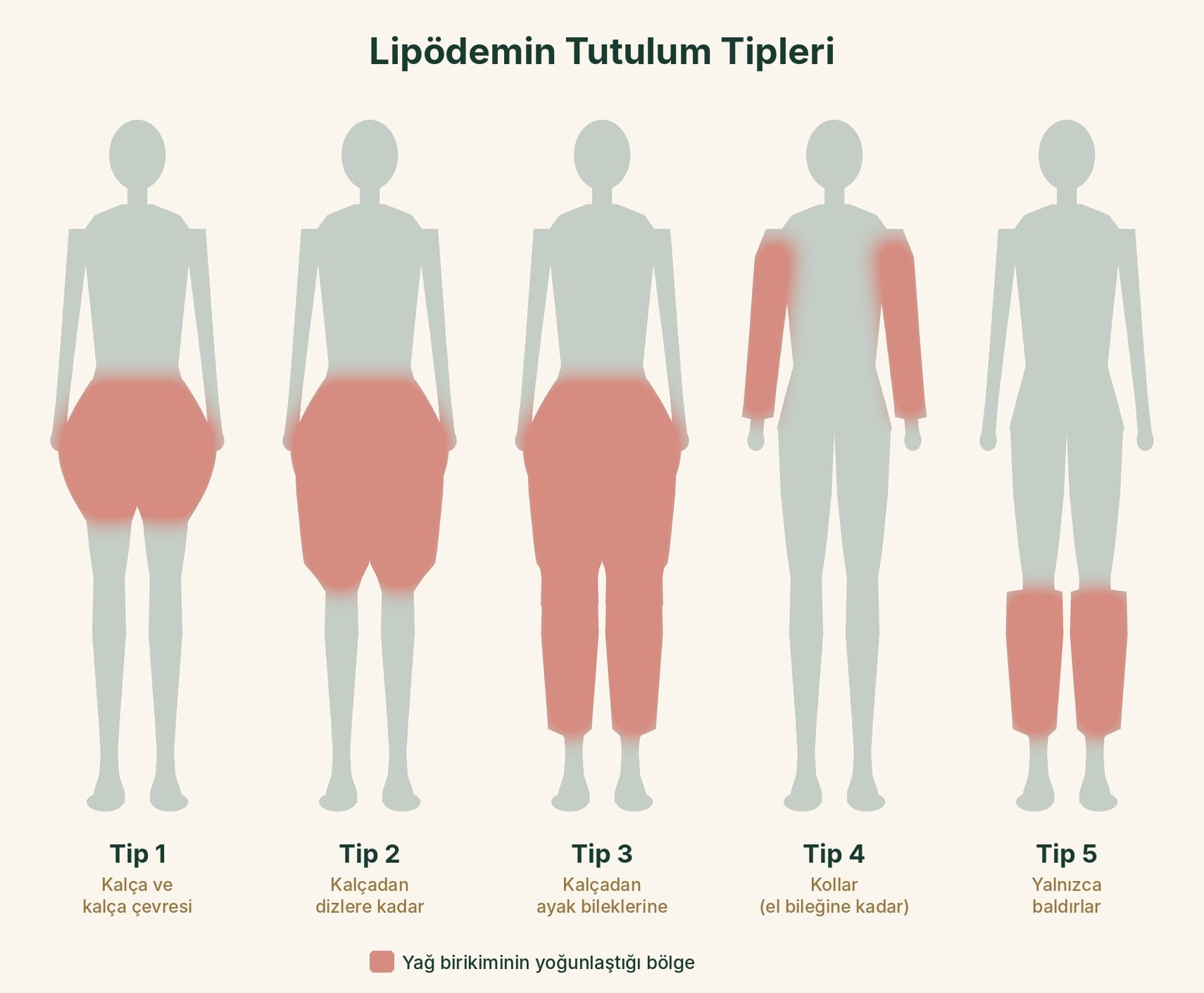 Lipödemin beş tutulum tipi: kalça, kalçadan dizlere, kalçadan ayak bileklerine, kollar ve yalnızca baldırlar